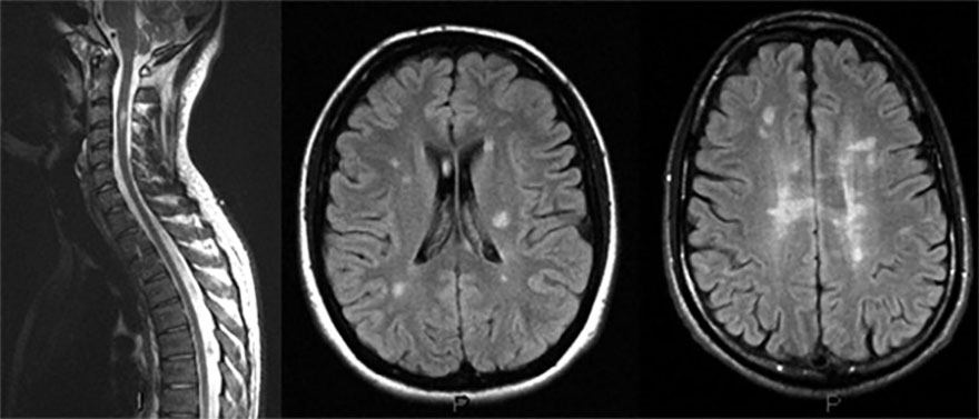 Diagnostic de la SEP - Clifransep